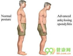 強(qiáng)直性脊柱炎的治療與管理 核心注意事項(xiàng)解析