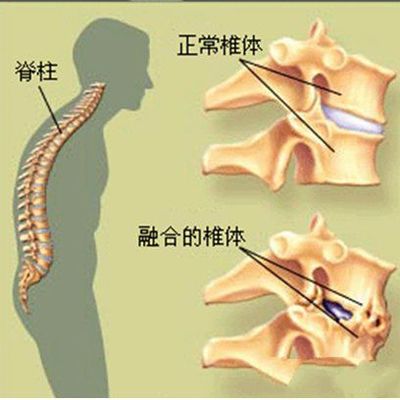 強(qiáng)直性脊柱炎的克星 小針刀療法的綜合應(yīng)用