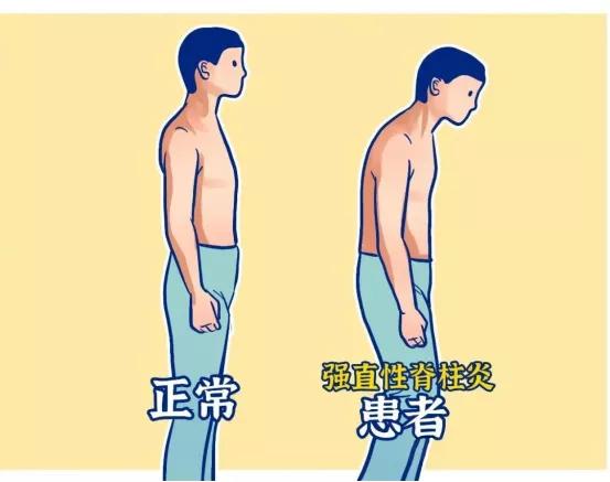 干細(xì)胞療法 吹響攻克強(qiáng)直性脊柱炎的沖鋒號(hào)